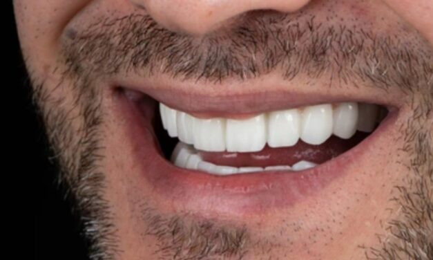 Chipped Tooth Repair