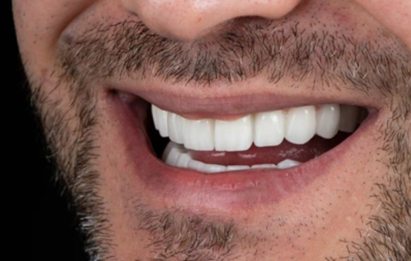 Chipped Tooth Repair