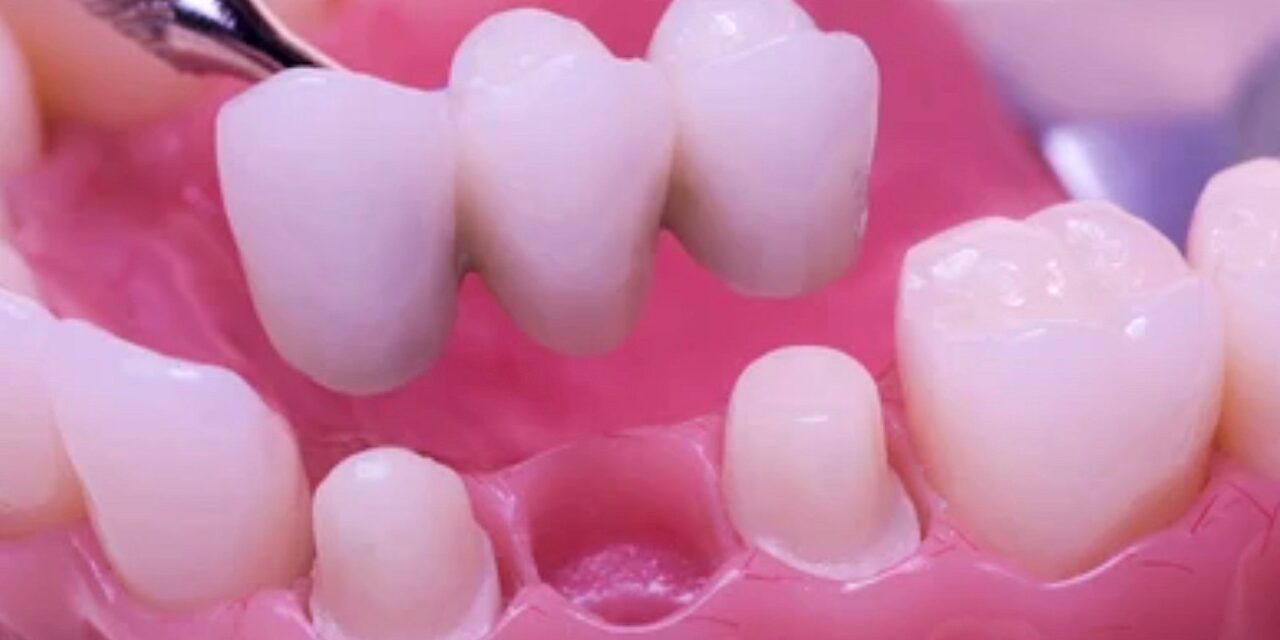 Dental Bridge