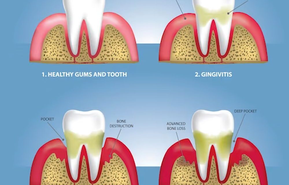 Early Periodontal Disease