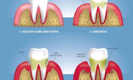 Early Periodontal Disease