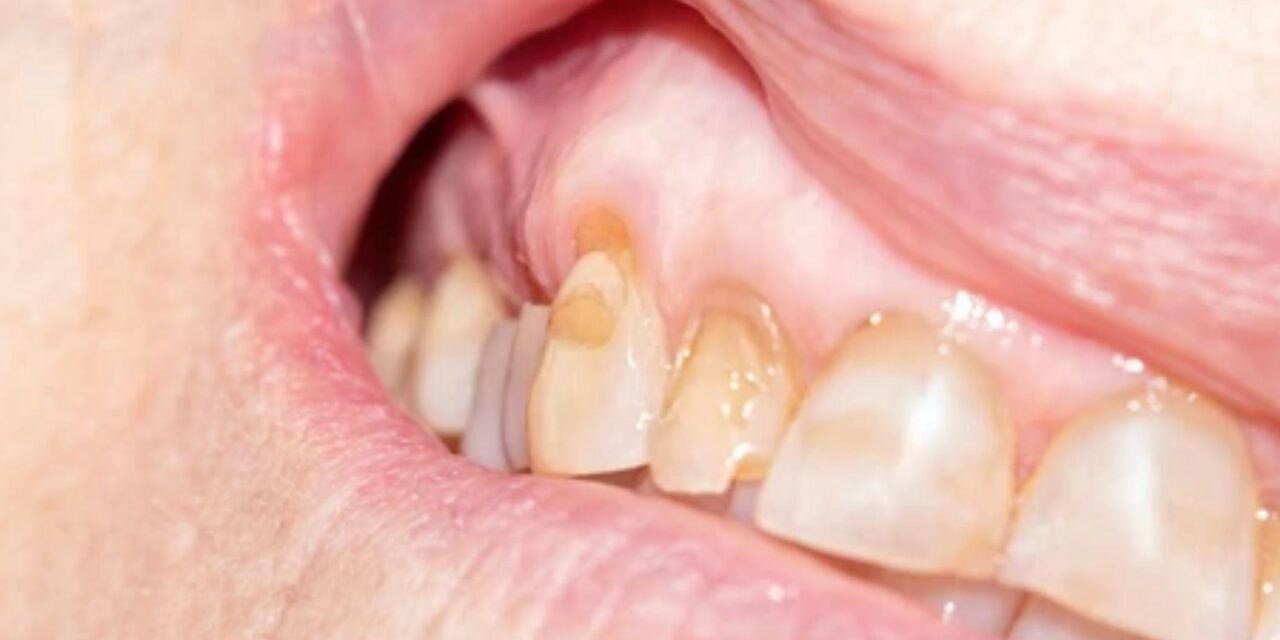 Exposed Dentin