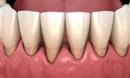 Gingival Recession