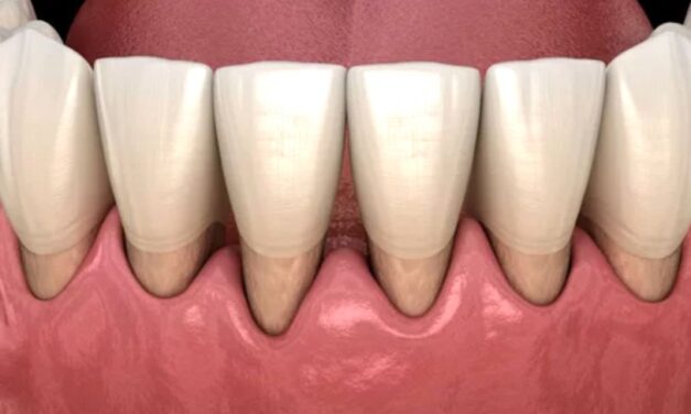 Gingival Recession