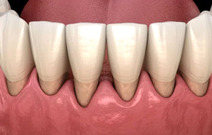 Gingival Recession