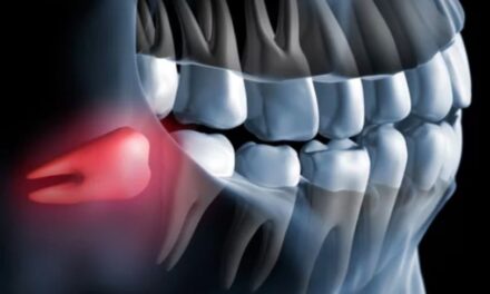 Wisdom Tooth Extraction